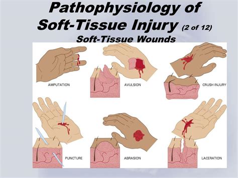 soft tissue injury pictures